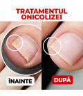 Soluție Intensivă pentru Unghii Fragile, Cuticule și Piele Active Care Solution StraDerm 30 ml
